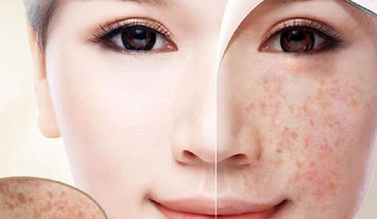 Ảnh banner bài viết Trị Nám Không Bong Nano Vàng Độc Quyền – Công Nghệ Hiện Đại Tại GPMA Beauty - Clinic